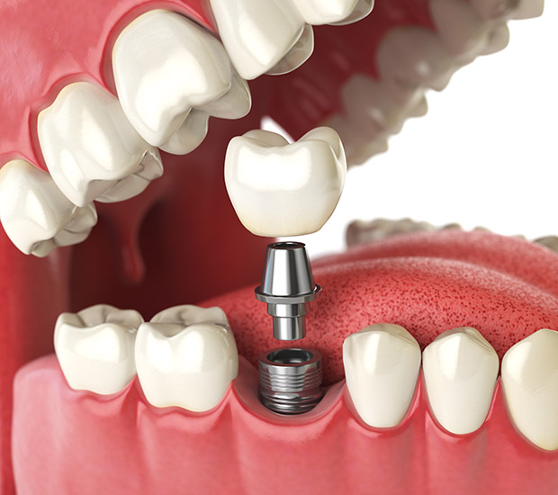 South Bend Will I Need a Bone Graft for Dental Implants