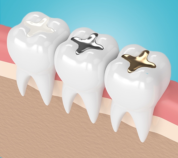 South Bend Composite Fillings