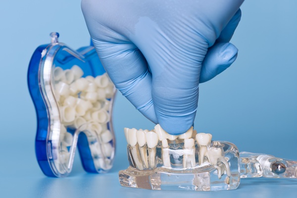 Benefits Of Dental Bridges