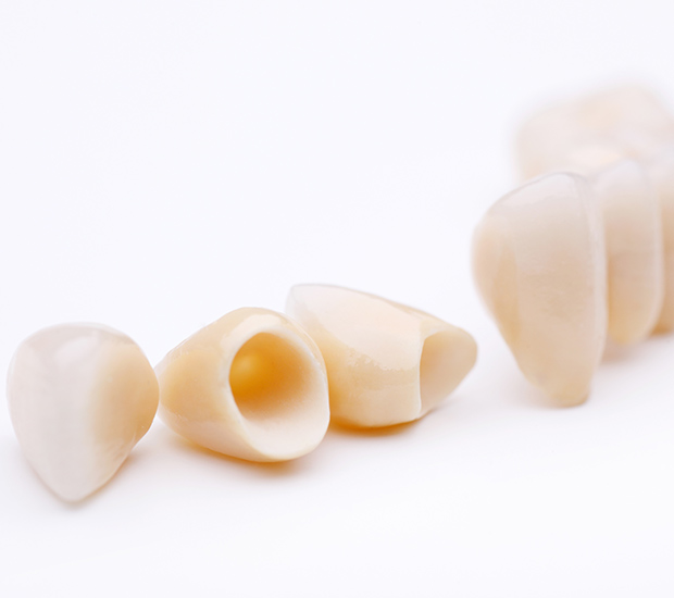 South Bend Dental Crowns and Dental Bridges