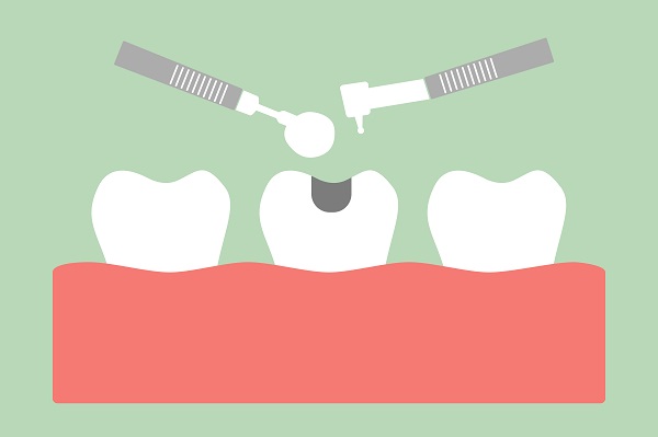 Three Questions To Ask Your Dentist About White Dental Fillings