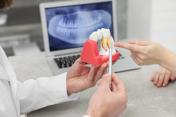 Benefits Of Dental Implants