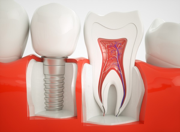 dental implant South Bend, IN