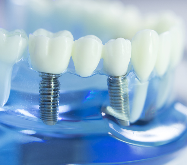 South Bend Dental Implants
