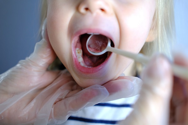 Types Of Dental Fillings For Kids Offered By A Kid Friendly Dentist In South Bend