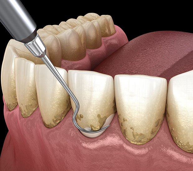 South Bend Root Scaling and Planing