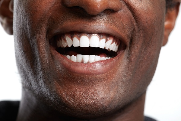 Benefits Of Professional Teeth Whitening